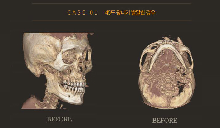 광대축소술은 이동하는것, 광대재위치술 관련 이미지 5