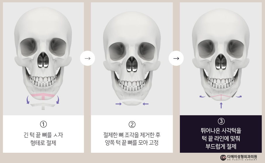 자연스러운 남자성형을 원한다면 관련 이미지 15