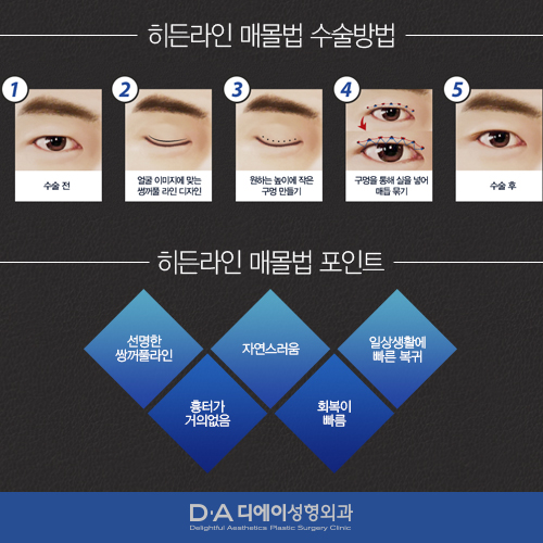 오직 남자만을 위한 DA성형외과 히든라인 눈성형 매몰법. 관련 이미지 3