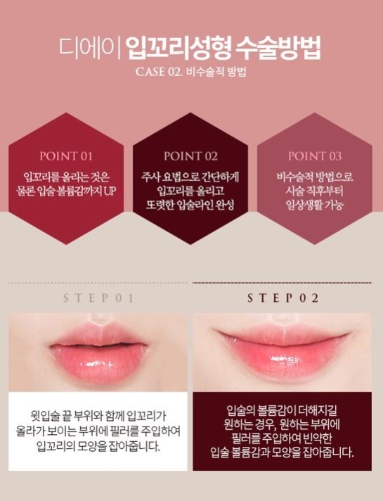 디에이성형외과 입꼬리성형으로 매력적인 미소를 가지다 관련 이미지 5