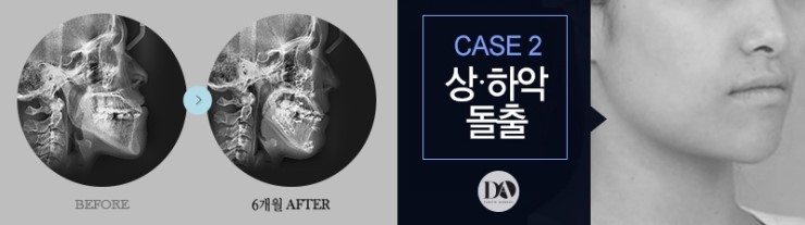 얼굴 유형에 따른 양악수술 솔루션 관련 이미지 8