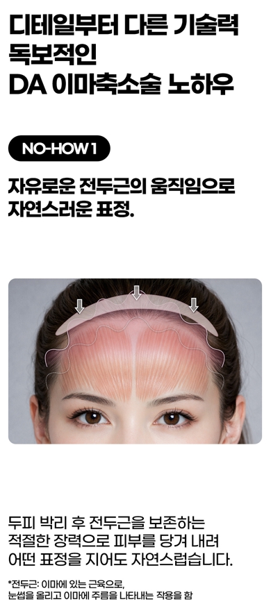 이마축소 수술, 헤어라인만으로 달라지는 얼굴 비율 관련 이미지 6