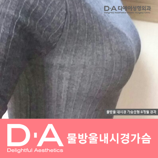 디에이성형외과의 자연스럽고 예쁜 물방울가슴성형 관련 이미지 6