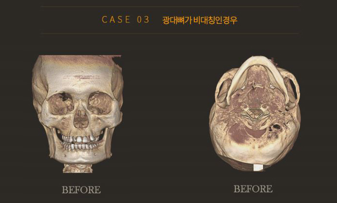 광대축소술은 이동하는것, 광대재위치술 관련 이미지 7