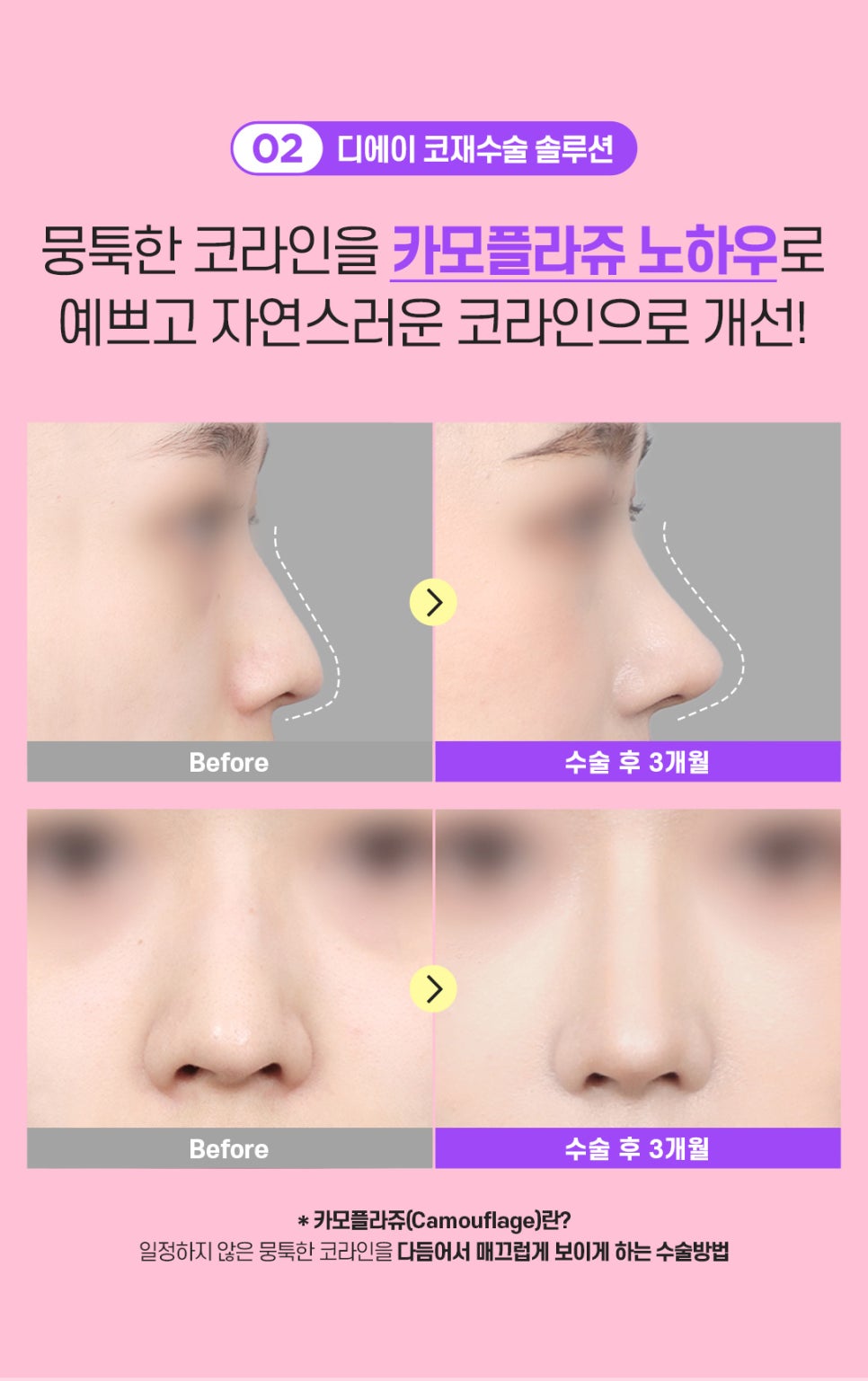 코재수술 후기 비용 신중하게 따져봐야 관련 이미지 5