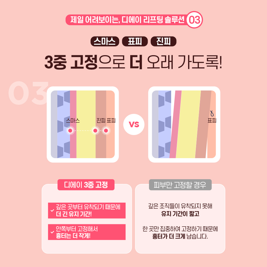 처진얼굴, 탄력개선에 효과적인 시술 방법 관련 이미지 8