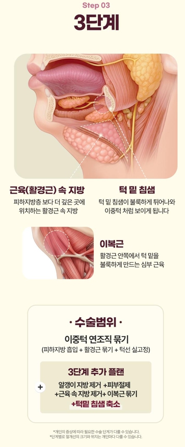 Double Chin Removal Surgery: Essential Information from Effects to Recovery Time image 9