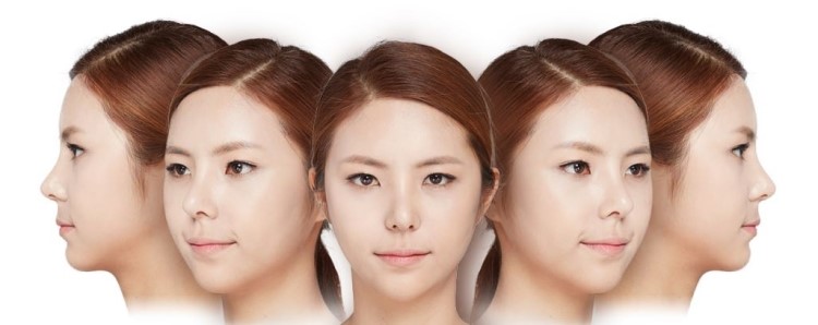 광대축소술은 이동하는것, 광대재위치술 관련 이미지 4