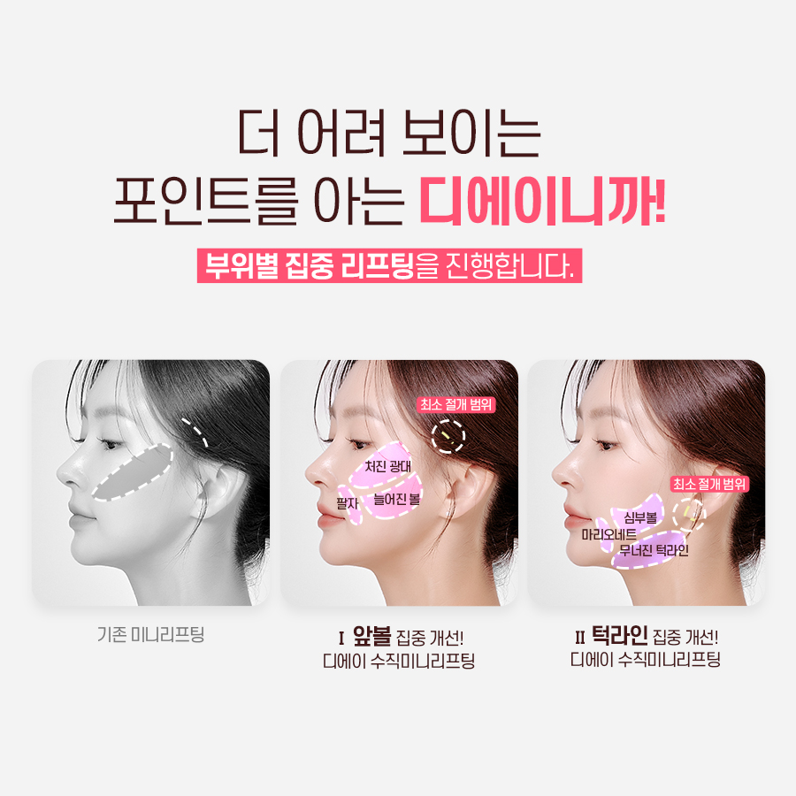 처진얼굴, 탄력개선에 효과적인 시술 방법 관련 이미지 12