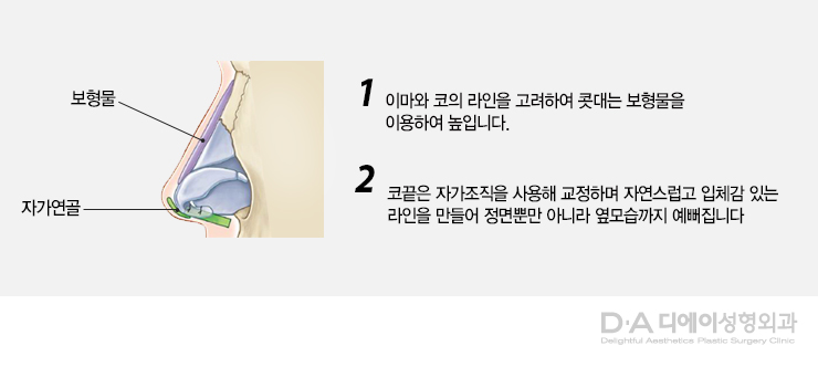 유형별 코성형의 특징과 방법 관련 이미지 5