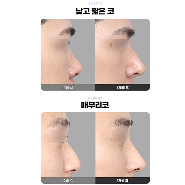 Type-Specific Male Rhinoplasty: A Natural, Refined Impression That Feels Like Your Own Nose image 10