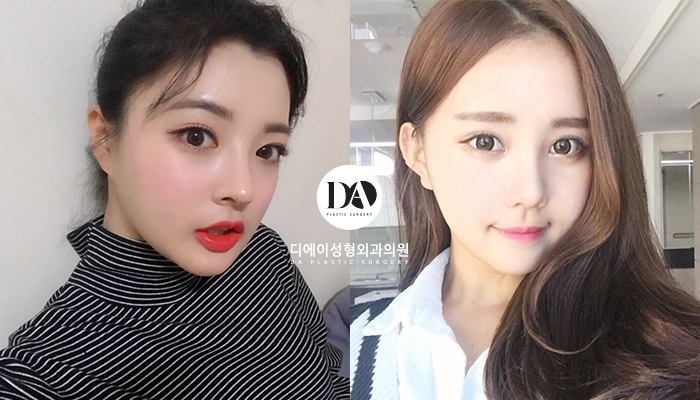 성공적인 눈성형, 관건은 눈형태에 따른 수술법 선택 관련 이미지 10