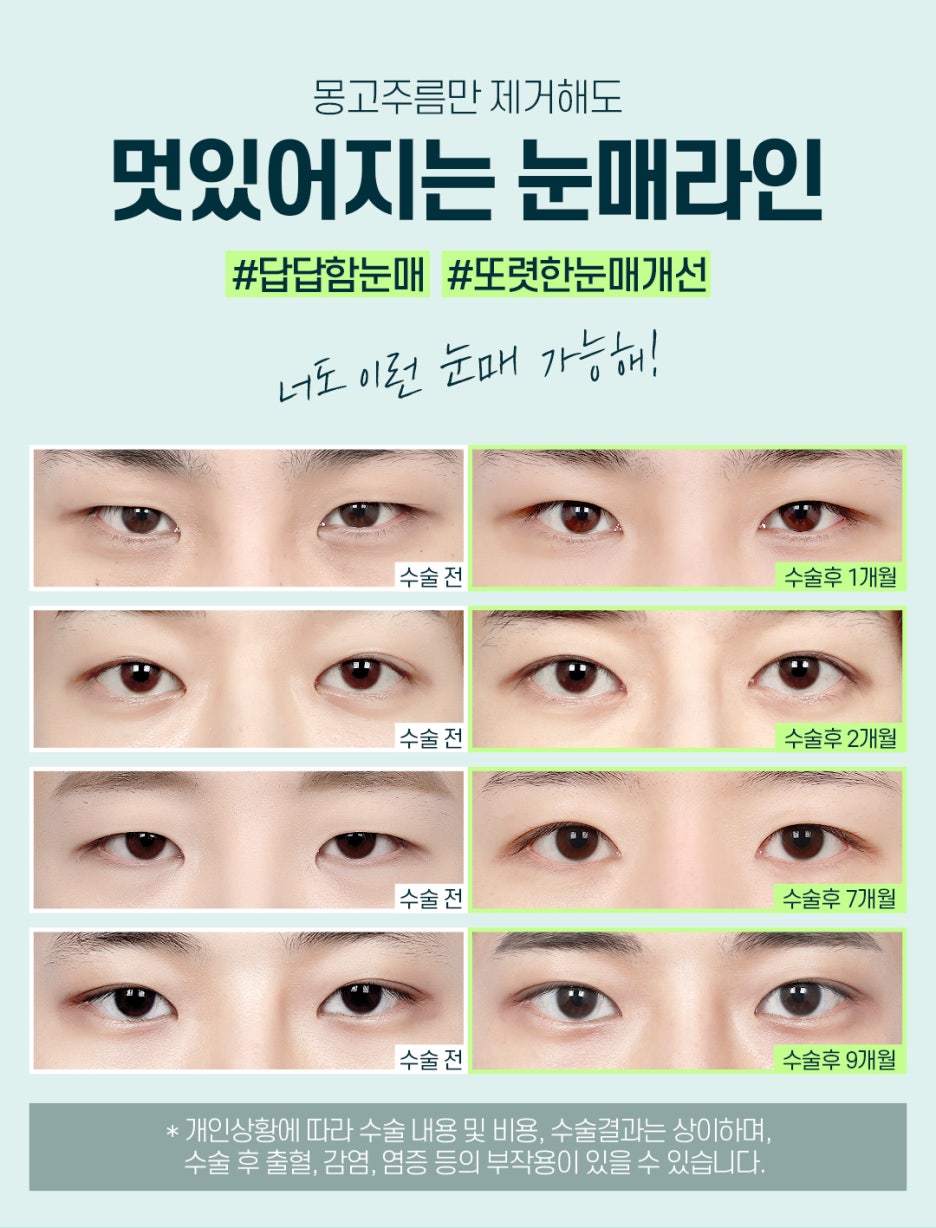 남자앞트임성형 꼼꼼하게 알아보는 법 관련 이미지 6