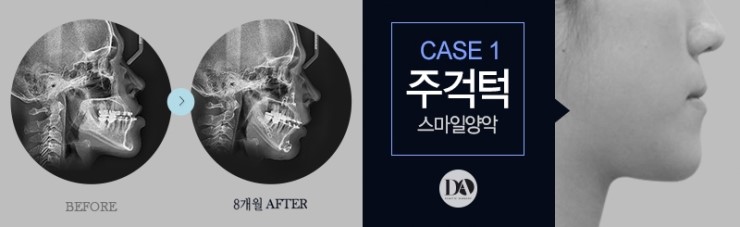 얼굴 유형에 따른 양악수술 솔루션 관련 이미지 7