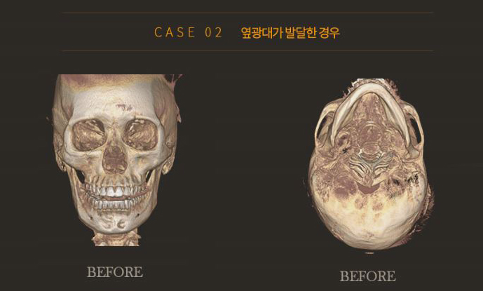 광대축소술은 이동하는것, 광대재위치술 관련 이미지 6