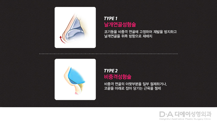 유형별 코성형의 특징과 방법 관련 이미지 12