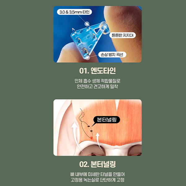 이마주름과 눈처짐을 동시에 개선, 수직 이마거상 관련 이미지 12