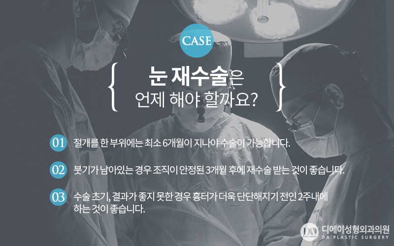 눈재수술 더이상의 실패는 NO! 관련 이미지 9