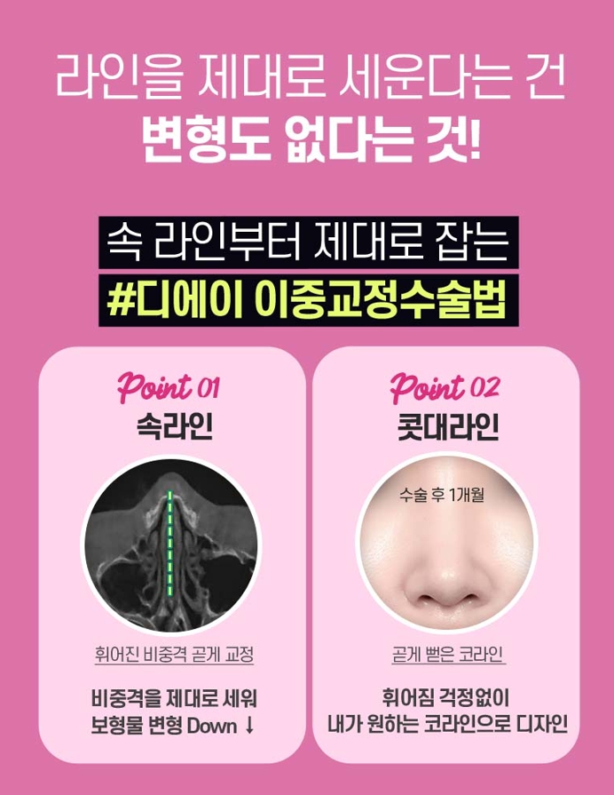비염미용코수술, 코막힘과 코 모양을 함께 고려하려면 관련 이미지 3