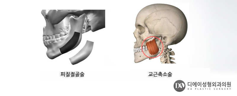 안면윤곽 수술 전 체크사항 관련 이미지 6