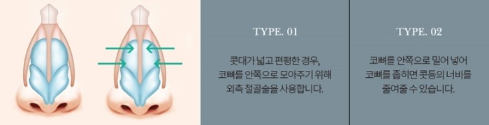 이상적인 코성형, 그 방법은? 관련 이미지 17