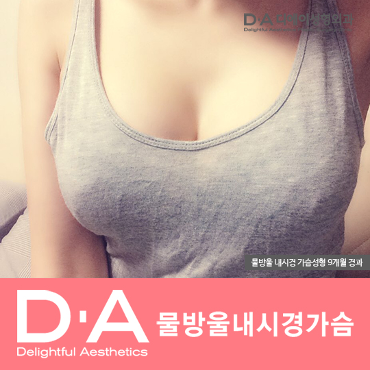 예쁜 모양, 자연스러운 라인! 디에이성형외과 관련 이미지 8