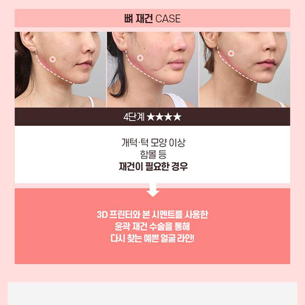 Not Satisfied After Your First Surgery? A Guide to Revision Facial Contouring Surgery image 5