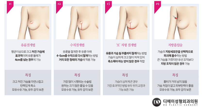 가슴성형 보형물 선택 방법 관련 이미지 11
