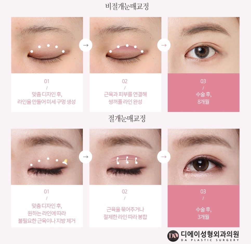 내 눈에 꼭 맞는 수술법은 무엇? 관련 이미지 11