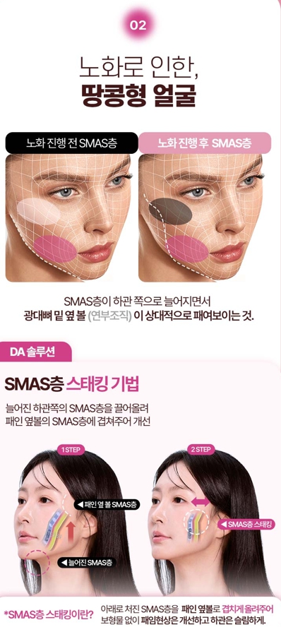 수직미니거상, 자연스러운 리프팅을 원한다면 알아볼 점 관련 이미지 4
