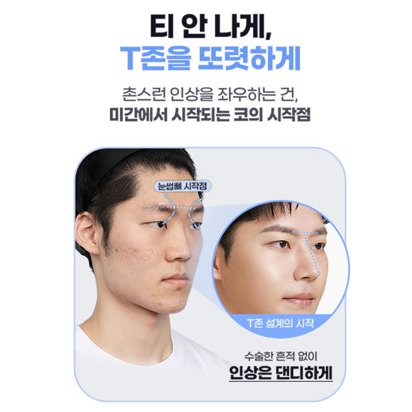 Type-Specific Male Rhinoplasty: A Natural, Refined Impression That Feels Like Your Own Nose image 5