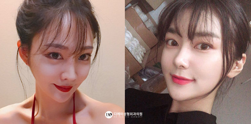 디에이성형외과 성형모델, 눈을 뗄 수 없네 관련 이미지 10