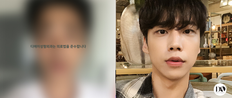 디에이성형외과 눈성형, 예쁘면DA야 관련 이미지 7