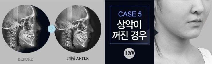 얼굴 유형에 따른 양악수술 솔루션 관련 이미지 11