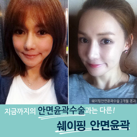 최소 절제, 최상의 효과! DA성형외과 쉐이핑안면윤곽 관련 이미지 2