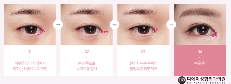 내 눈에 꼭 맞는 수술법은 무엇? 관련 이미지 5