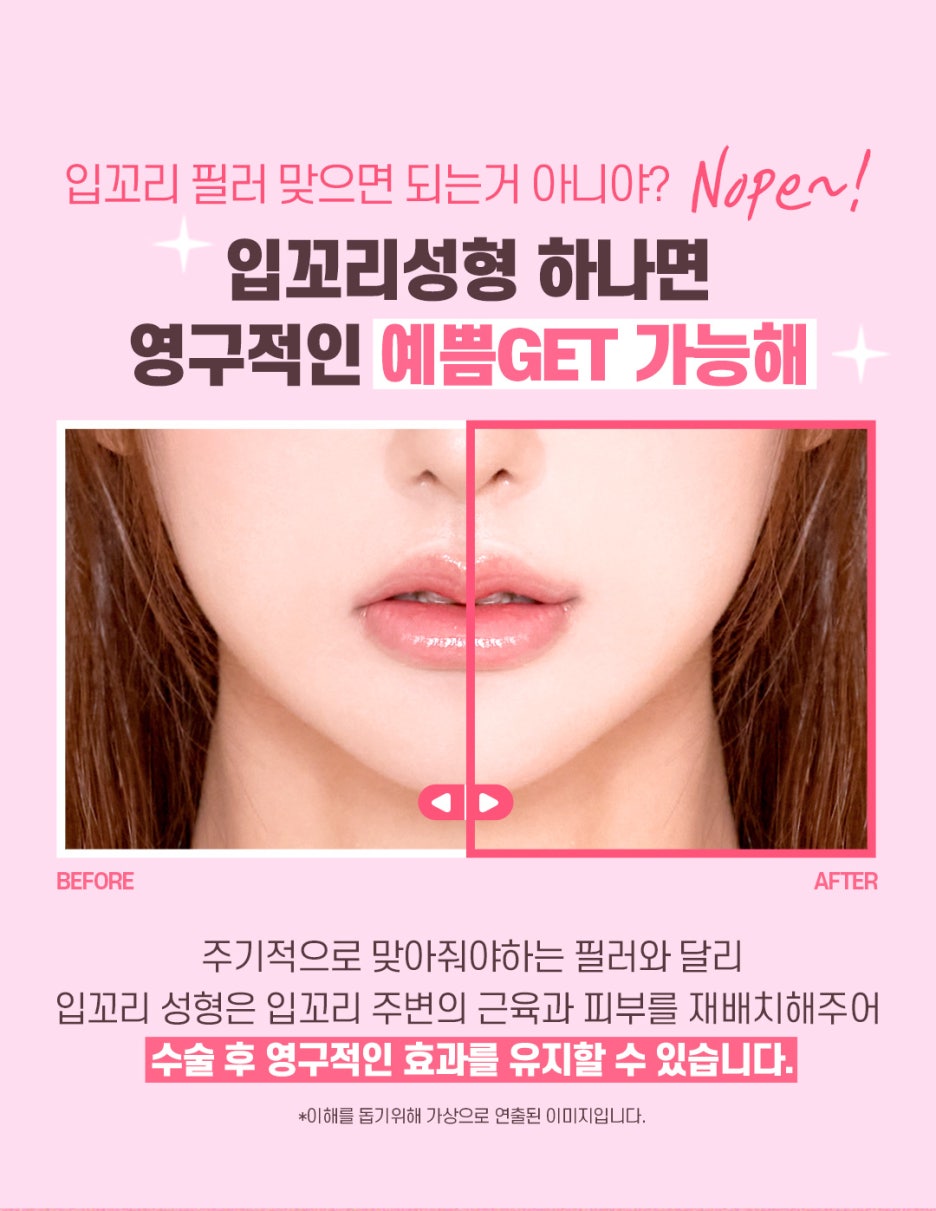 입꼬리성형 만족도 통증 효과 비용 궁금하다면? 관련 이미지 3