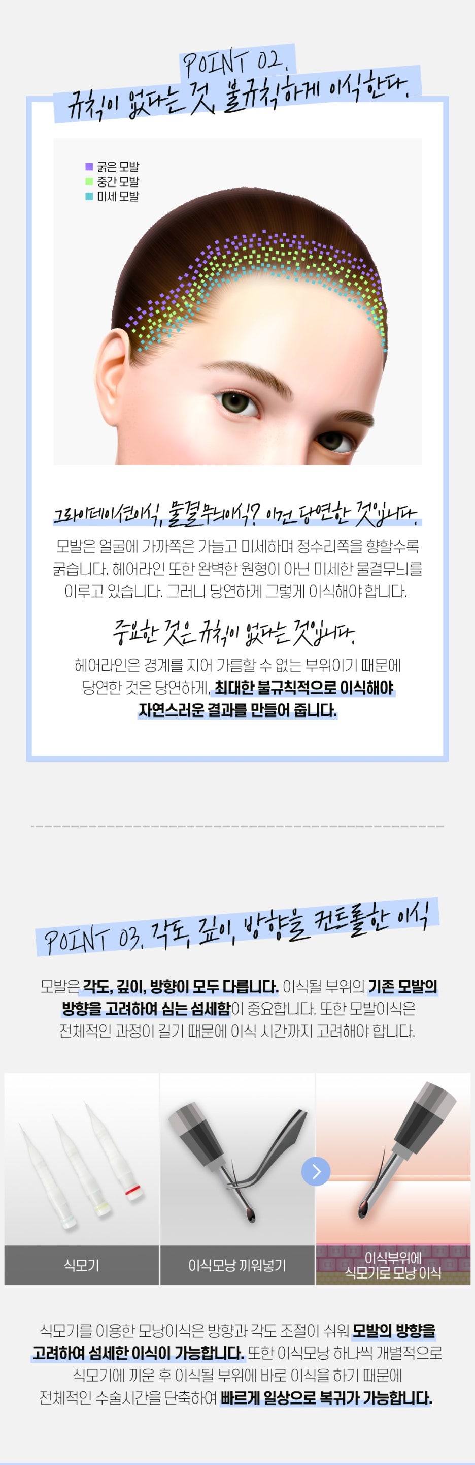 헤어라인 모발이식으로 인형외모갖기 관련 이미지 6
