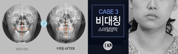 얼굴 유형에 따른 양악수술 솔루션 관련 이미지 9