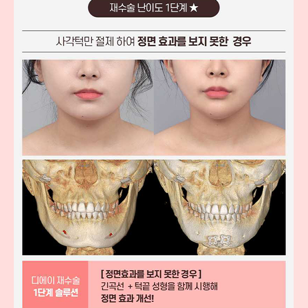 Not Satisfied After Your First Surgery? A Guide to Revision Facial Contouring Surgery image 6