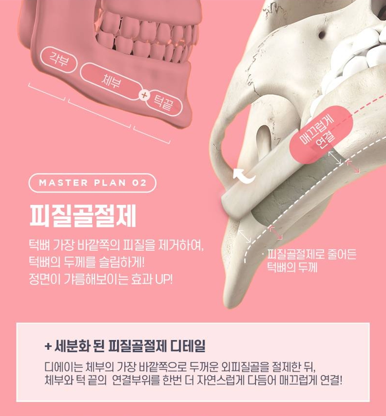 사각턱수술 비용보다 중요한 선택 기준은? 관련 이미지 4