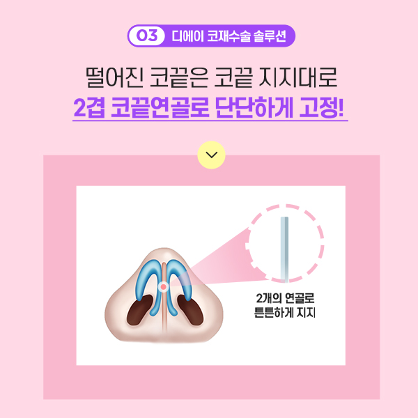 코재수술의 종착점, 더 이상 실패하지 않는 방법 관련 이미지 5