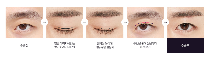 디에이성형외과 맞춤 남자눈성형 솔루션 관련 이미지 6