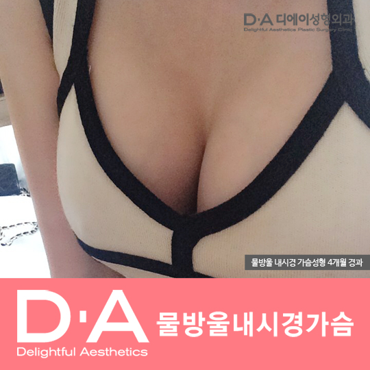 예쁜 모양, 자연스러운 라인! 디에이성형외과 관련 이미지 4