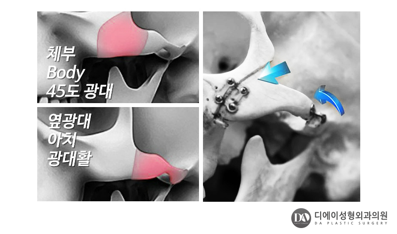 안면윤곽 재수술 체크리스트 관련 이미지 13