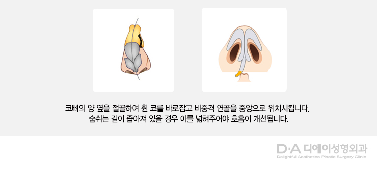 유형별 코성형의 특징과 방법 관련 이미지 12