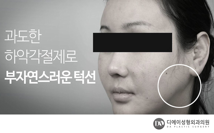 안면윤곽 재수술 체크리스트 관련 이미지 8