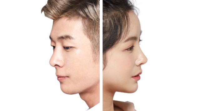 이상적인 코성형, 그 방법은? 관련 이미지 4