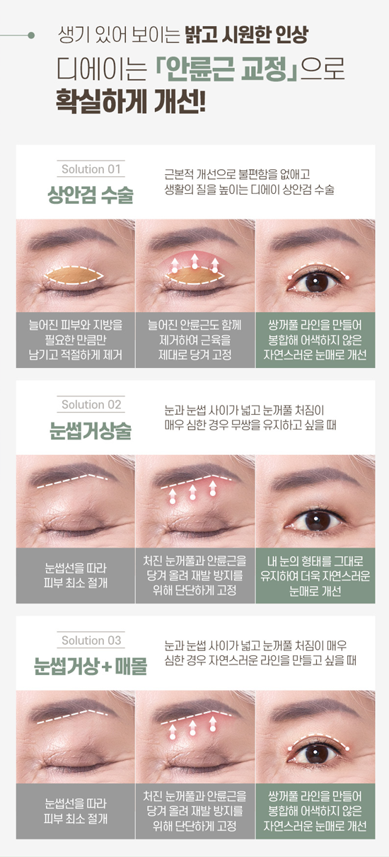 디에이성형외과 중년눈성형, 상안검수술 관련 이미지 5