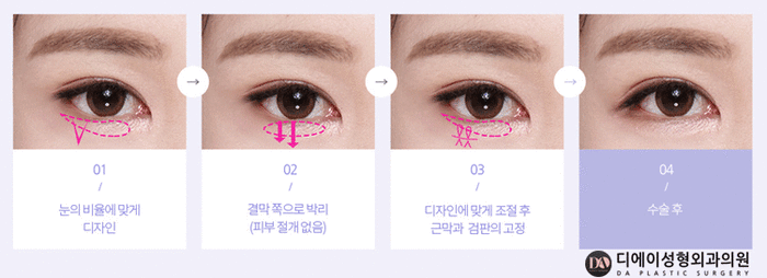 성공적인 눈성형, 관건은 눈형태에 따른 수술법 선택 관련 이미지 17